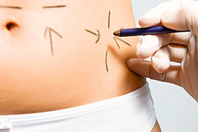 Abdominoplastia en Cancún Tummy Tuck